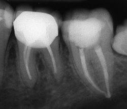 Два зъба, пролекувани ендодонтски
